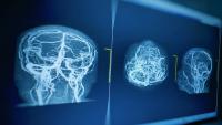 Brain scan on screen.